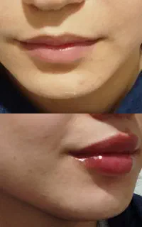بوتاکس،انواع فیلر ومزوتراپی (وعمل های زیبایی زنان)