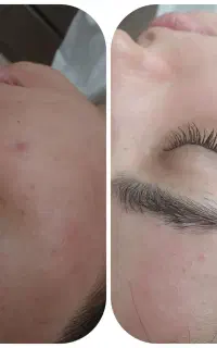 تخفیف ویژه پاکسازی تخصصی پوست فقط ۲۵۰ت