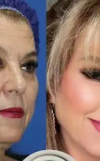 مدل جوانسازی شفافسازی چروک لیفت پوست به مدت محدود