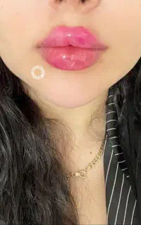 تزریق ژل لب