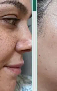 رفع لک و تیرگی پوست و تزریق ژل و بوتاکس