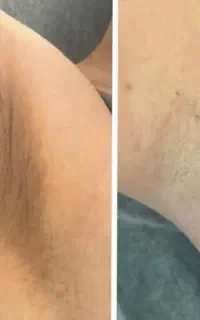 روشن سازی نواحی تیره بدن و صورت(مایابیوتی)