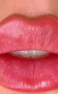 تزریق ژل وفیلر وبوتاکس بصورت تضمینی با آف 70 درصدی