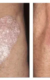 آرامش پوست حق شماست پایانی بر التهاب و خارش