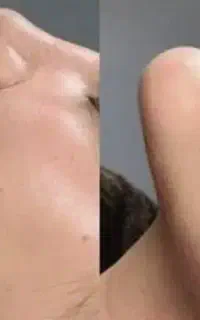 ساکشن غبغب و زاویه سازی فک