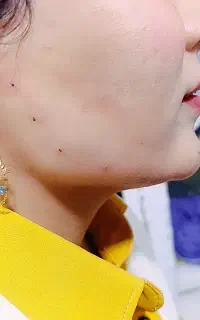 تخفیف ی ماهه تزریق ژل و بوتاکس در مطب