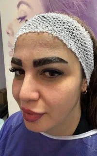 کاشت ابرو اقساطی توسط پزشک