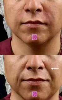 فیلر بوتاکس طب سوزنی