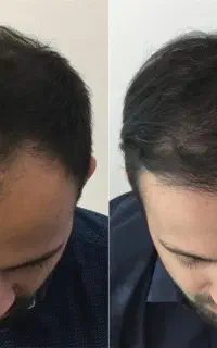 یکاری بکن واسه موهات قبل اینکه کلا کچل بشی
