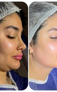 ابدومینوپلاستی/لیپو ساکشن/ماموپلاستی /ژینکو ماستی