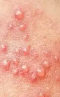 پاک سازی ریشه ای  زگیل و تبخال تناسلی