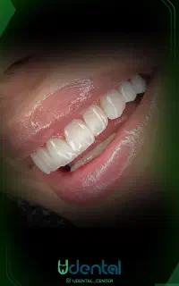 ایمپلنت کامپوزیت لمینت با شرایط ویژه اقساطی