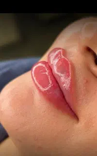 تزریق فیلر لب و بوتاکس
