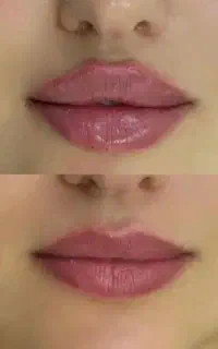 ساکشن / فیلر بادی و صورت/ بوتاکس/ پی ارپی مزوتراپی