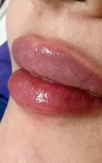 ژل،تزریق فیلر، جوانساز،بوتاکس توسط پزشک/ لیفت صورت
