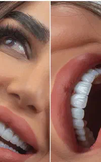 کامپوزیت دنتال(بدون پیش پرداخت/از دم قسط)