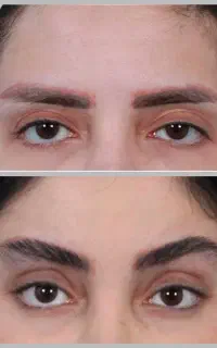 لیفت اروپایی دایمی بدون بخیه