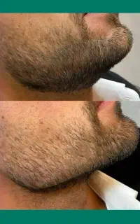 کانتور و زاویه سازی/خانم و آقا/توسط پزشک