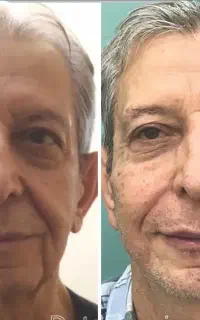 لیفت تخصصی صورت بدون جراحی با نخ سرپایی