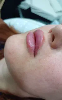 آف ویژه ژل بوتاکس مزو