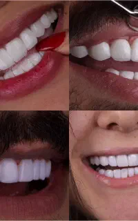 کامپوزیت لمینت