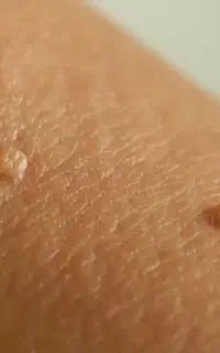 حذف خال های گوشتی