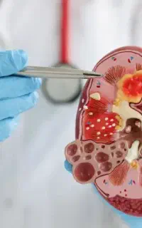 سنگ کلیه هاتو بنداز دور
