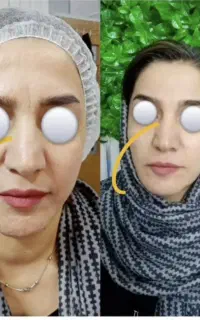 جدیدترین روش زیبایی کاملا غیر تهاجمی زیر نظر پزشک