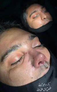تخفیف جراحی بینی فقط 45 ملیون اهواز
