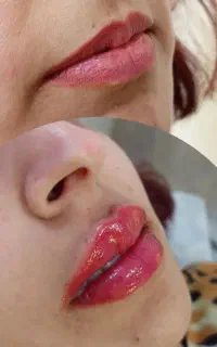 تخفیف ژل و بوتاکس