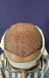 استخدام تکنسین کاشت مو