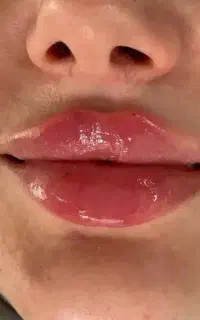 خدمات تزریقات فیلر،ژل،بوتاکس،ژل لب ، گونه فقط ۶۰۰ت