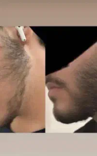 رویش ریش سبیل