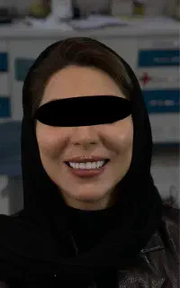 کامپوزیت زیبایی دندان