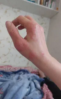 رفع حساسیت های فصلی و پوستی اگزما و...