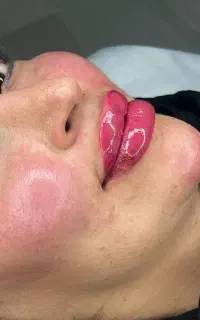 ژل بوتاکس مادلینگ عربی بادی جوانساز