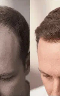 انقدر به سرت ماینوکسیدیل نزن