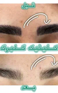 ریموو تتو ابرو و بدن(گلبرگ)