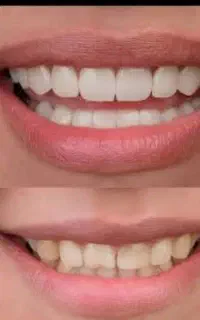 کامپوزیت وجرم گیری ورفع پوسیدکی دندان