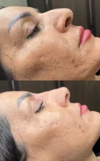 تخفیف 30 درصد ژل بوتاکس فیلر صورت و بدن تضمینی