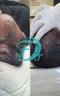 پزشک بوتاکس پی ار پی ژل مزوتراپی لیزر مسکن