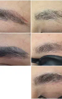 پاک کردن تتو/لیزر موهای زائد/الکترولیز/فیشیال/خال