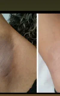 روشن سازی تخصصی صورت+بدن دستگاه لیزر آلمانی+کربن