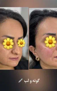 تزریق فیلر و مزو و انزیم