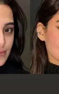 ژل بوتاکس700فول فیس با4500تومان توسط پزشک مجرب