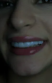 کامپوزیت دندانپزشکی عصب‌ کشی ۴۵۰۰ روکش واحدی۵۵۰۰