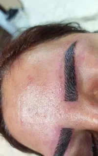 میکرو فیبروز. هاشور