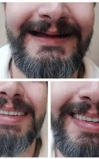 دندانسازی  دندان مصنوعی  با تخفیف ویژه
