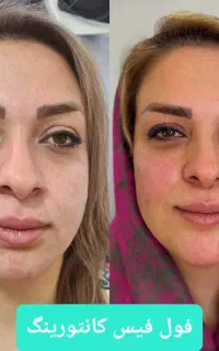 جشنواره و تخفیفات تزریقات زیبایی توسط پزشک