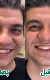 کامپوزیت دندان / تخفیف 50 درصدی